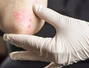 20 meilleurs remèdes contre le psoriasis
