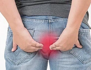 Top 10 des remèdes contre les hémorroïdes