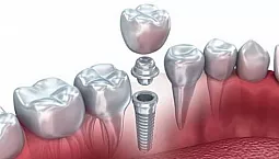 10 meilleures cliniques d'implants dentaires à Moscou