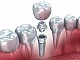 10 meilleures cliniques d'implants dentaires à Moscou