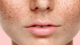 15 meilleurs remèdes contre les taches de vieillesse sur le visage