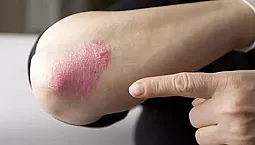 5 meilleures vitamines pour le psoriasis
