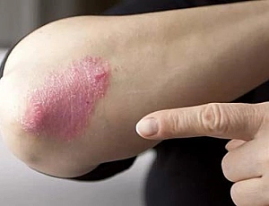 5 meilleures vitamines pour le psoriasis
