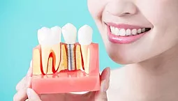 5 meilleurs fabricants d'implants
