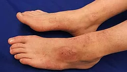 15 meilleurs remèdes contre l'eczéma