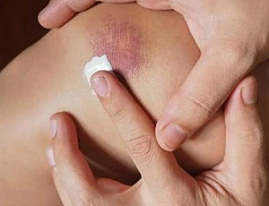 10 meilleurs remèdes contre les ecchymoses et les contusions