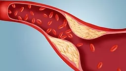 10 meilleurs médicaments anti-cholestérol avec iherb