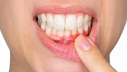 10 meilleurs dentifrices pour la parodontite et les maladies parodontales