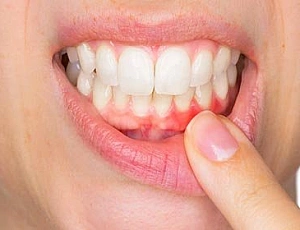 10 meilleurs dentifrices pour la parodontite et les maladies parodontales