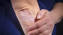 10 meilleurs remèdes non hormonaux pour le psoriasis