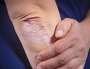 10 meilleurs remèdes non hormonaux pour le psoriasis