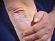 10 meilleurs remèdes non hormonaux pour le psoriasis