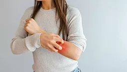 10 meilleurs remèdes contre la dermatite avec iHerb