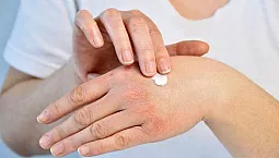 10 meilleurs remèdes contre le psoriasis avec iHerb