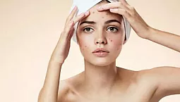 10 meilleurs traitements contre l'acné avec iHerb