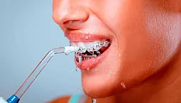 5 meilleurs irrigateurs pour appareils dentaires