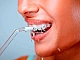 5 meilleurs irrigateurs pour appareils dentaires